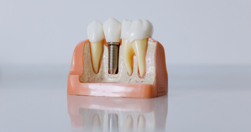 Cross-section dental model showing a dental implant fused into the jawbone beside two natural teeth