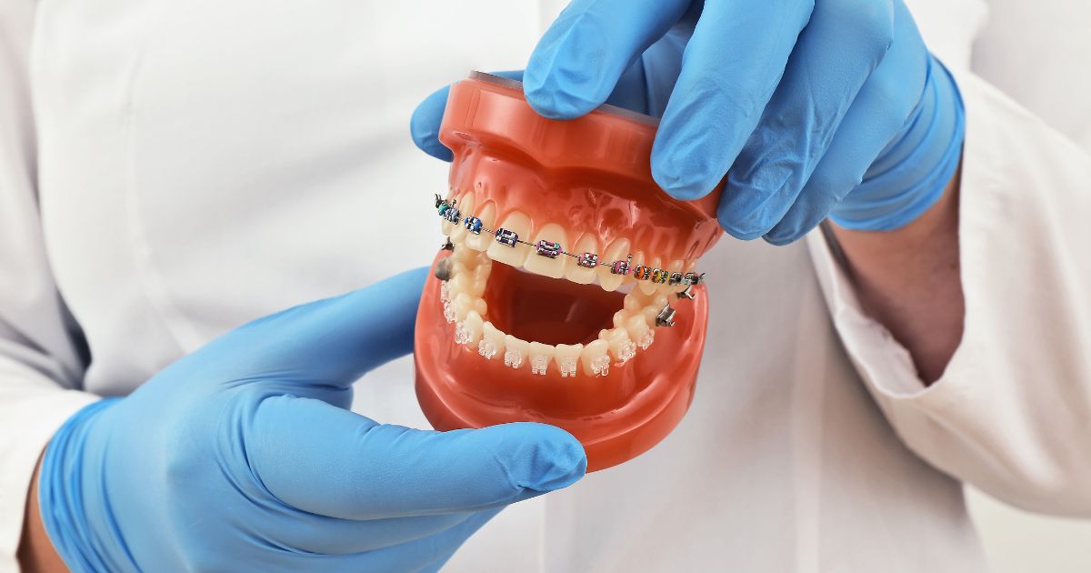 Dentist in gloves holding a dental model fitted with braces to demonstrate treatment