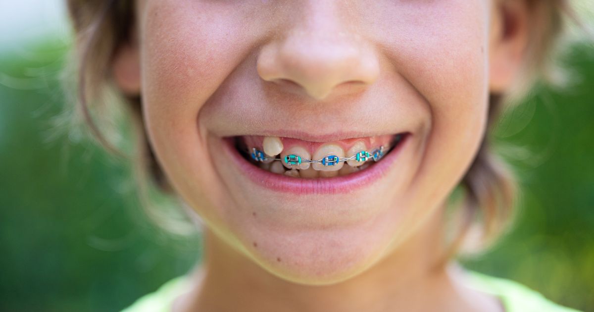 Read more about the article Braces for Kids in Johannesburg: The Right Age and When to See an Orthodontist